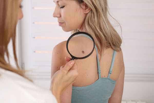 What Are Traditional Skin Lesion Removal Methods West Sussex?
