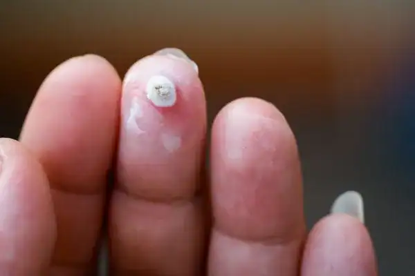 Image of white wart before cryopen treatment West Sussex