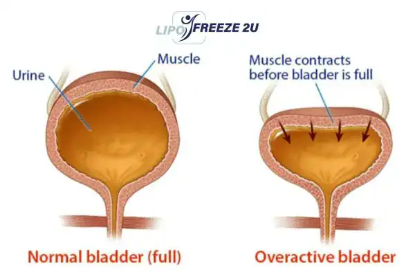 diagram of overactive bladder treatment West Sussex