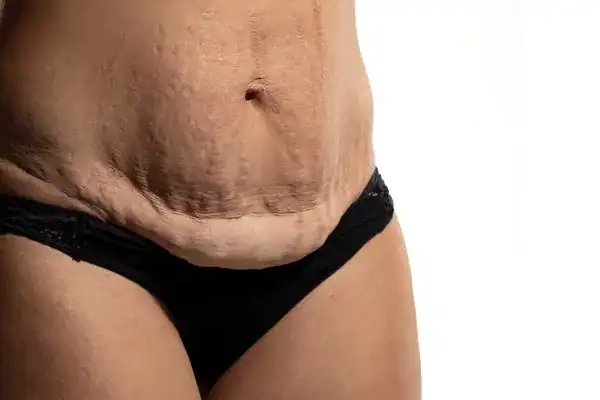 loose skin after weight loss injections West Sussex