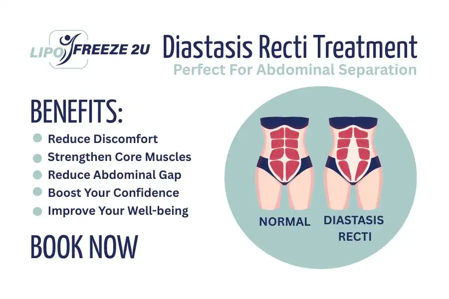 How Long Will It Take to See Improvements in Diastasis Recti West Sussex