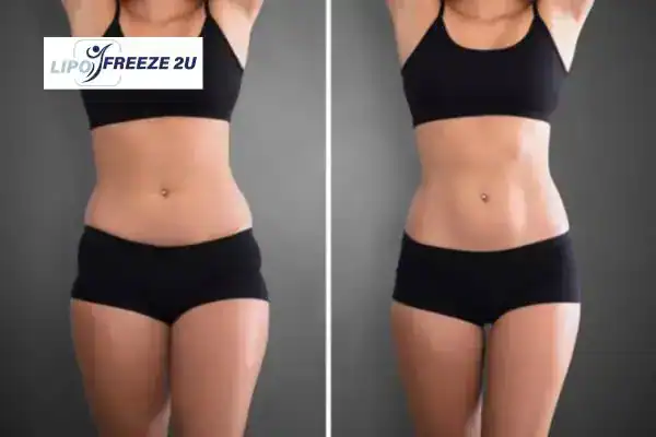 How Can LIPO FREEZE 2U Support Your Post-Pregnancy Body Recovery West Sussex?