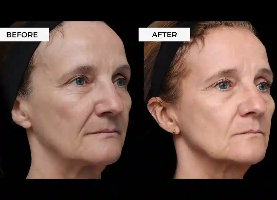 How Many RF Microneedling Sessions Will You Need to See a Difference West Sussex?
