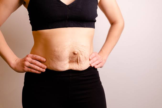 Is Surgery Really the Only Way to Repair Diastasis Recti West Sussex?