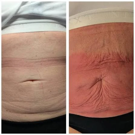 How Does RF Microneedling Improve Crepey, Thin and Uneven Skin Texture West Sussex?