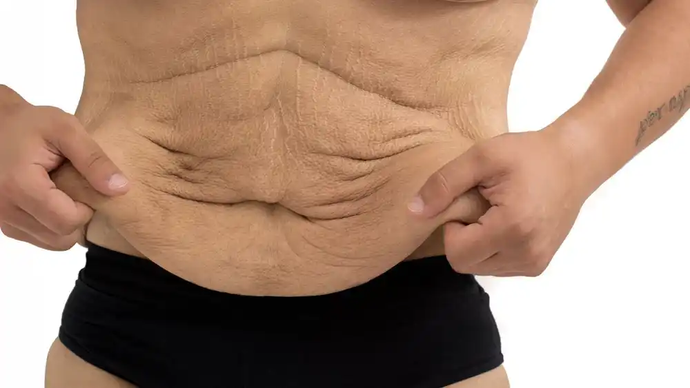 RF Microneedling for Loose Skin: How Can It Help Tighten and Reshape the Skin West Sussex?
